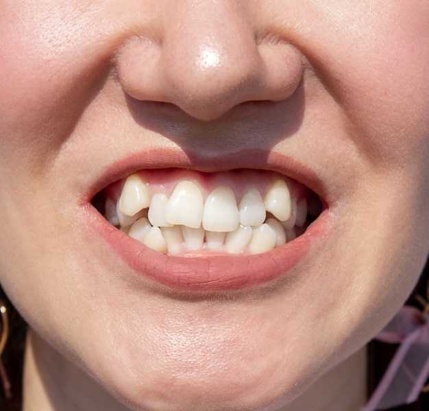 Les dents en porcelaine en rêve : un symbole fréquent